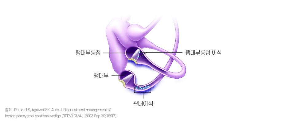 이석증 발생 원리