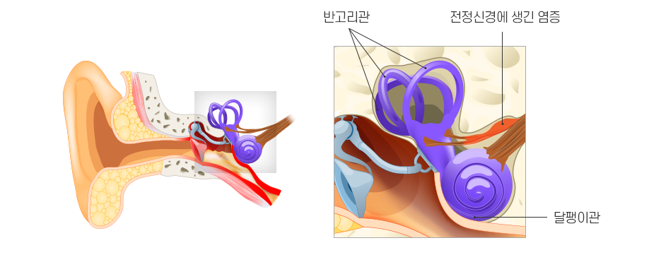 전정신경염 설명