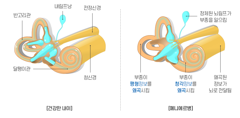 메니에르병 설명
