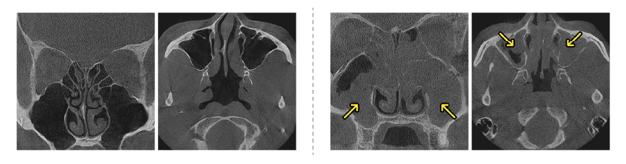 부비동 내시경 수술 설명