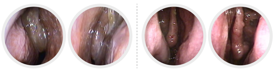 부비동 내시경 수술 설명 2
