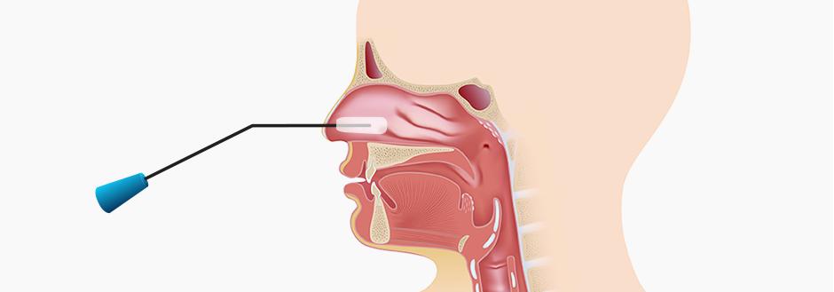고주파비염수술 설명 1