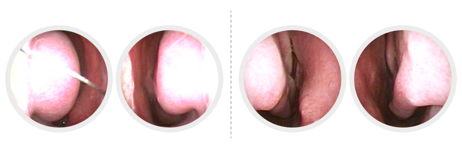 고주파비염수술 설명 2