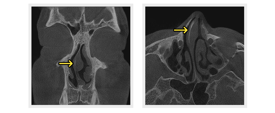 비중격 교정술 설명