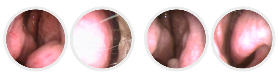 비중격 교정술 설명 2